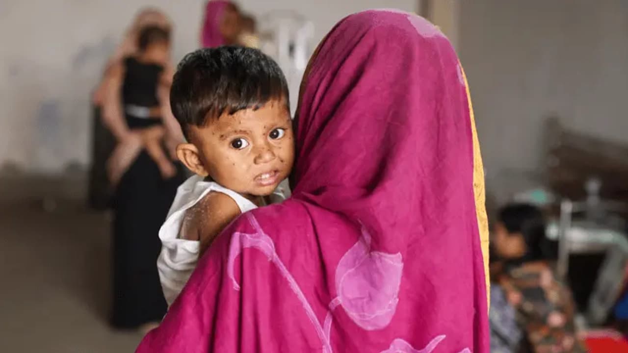 হামের উপসর্গে আরও ৬ শিশুর মৃত্যু, প্রাণহানি বেড়ে ৮১৬