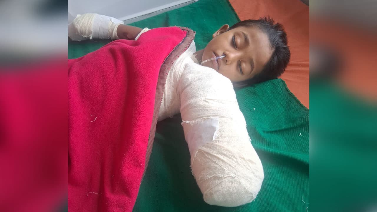 ট্রান্সফরমারের স্পার্কে দগ্ধ ৫ বছরের শিশু, কেটে ফেলা হলো হাত