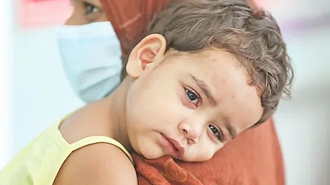 হামের উপসর্গ নিয়ে ২৪ ঘণ্টায় ৫ শিশুর মৃত্যু