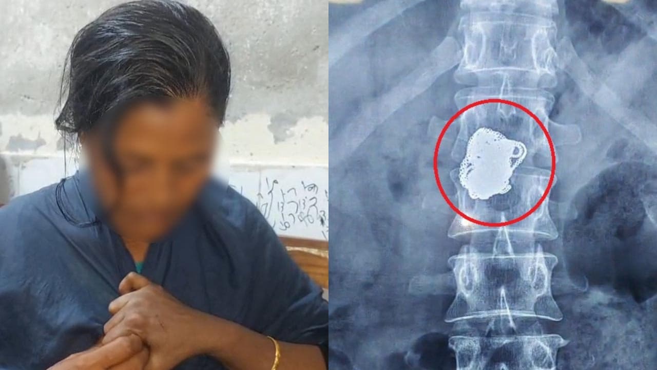 নারী চিকিৎসা সেজে স্বর্ণ চেইন চুরি করে গিলে ফেলল