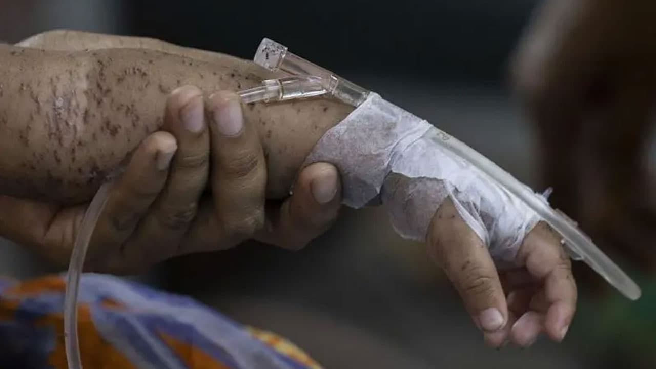 হামে ২৪ ঘণ্টায় ৪ মৃত্যু, মোট মৃত্যু ৯৮৩