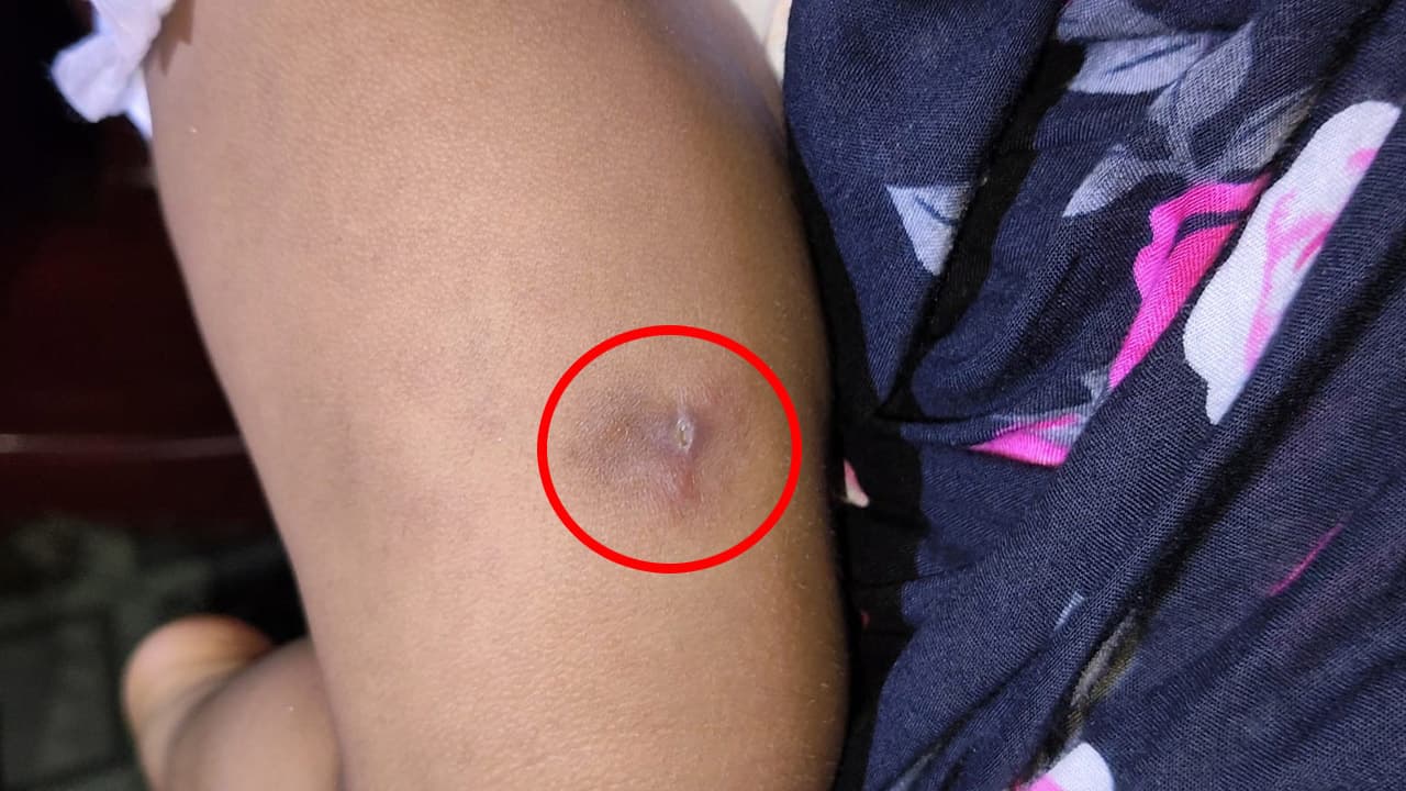 ভুল জায়গায় টিকা দেওয়ার পর শিশুর পায়ে পুঁজ ও রক্তক্ষরণ