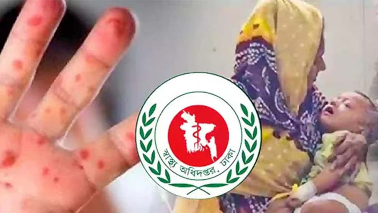 হাম ও উপসর্গে দেশে আরও তিন শিশুর মৃত্যু হয়েছে