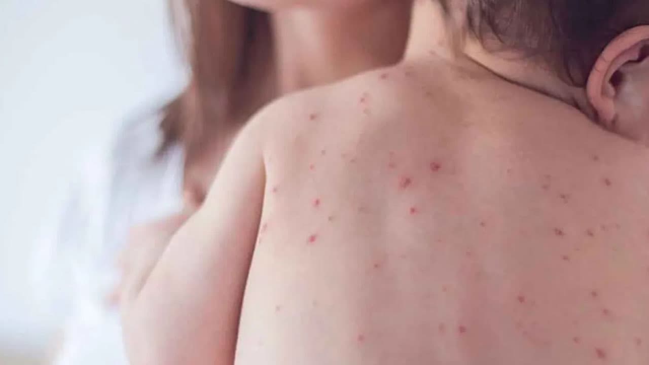 হাম ও উপসর্গে চলতি বছরেই ৯৯১ জনের মৃত্যু