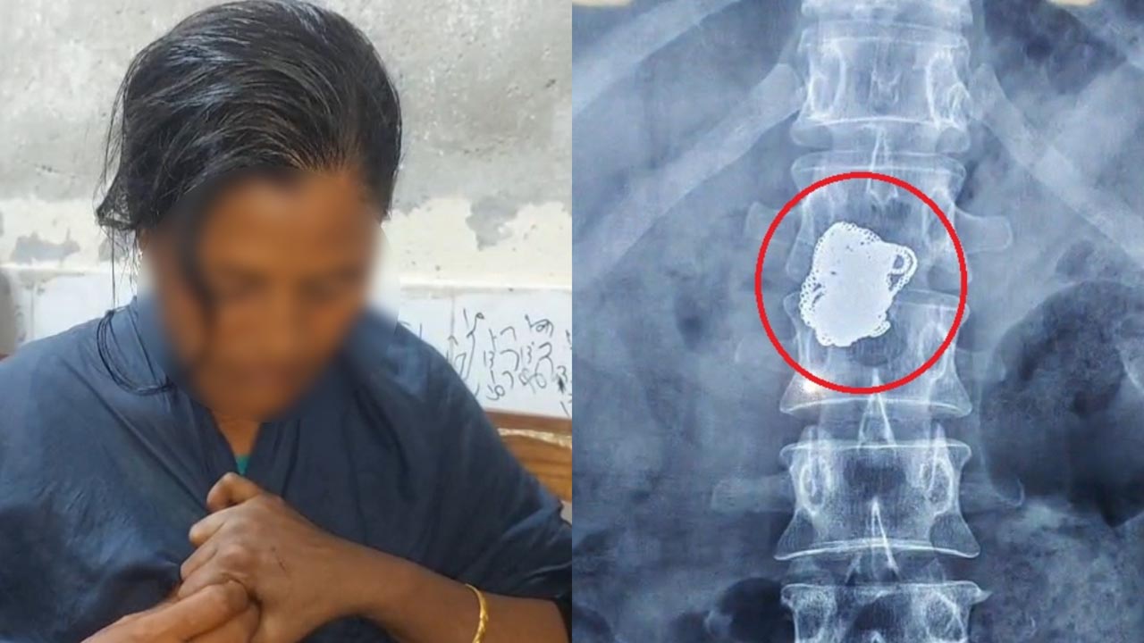 নারী চিকিৎসা সেজে স্বর্ণ চেইন চুরি করে গিলে ফেলল