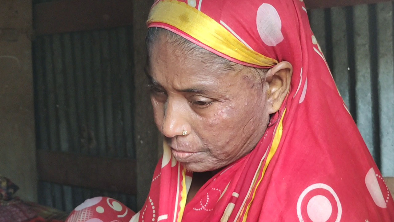 বরগুনায় চর্মরোগ ও ডায়রিয়ার প্রকোপ বৃদ্ধি, বিদ্যুৎকেন্দ্রের প্রভাব নিয়ে প্রশ্ন